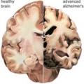alzheimers_brain.jpg