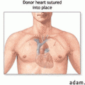 heart-transplant-02.gif