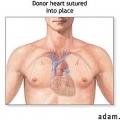 heart-transplant-02.jpg