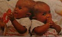 Mpho Mathibela, one of the Siamese twins separated in an operation six months earlier, leaves hospital for the first time 